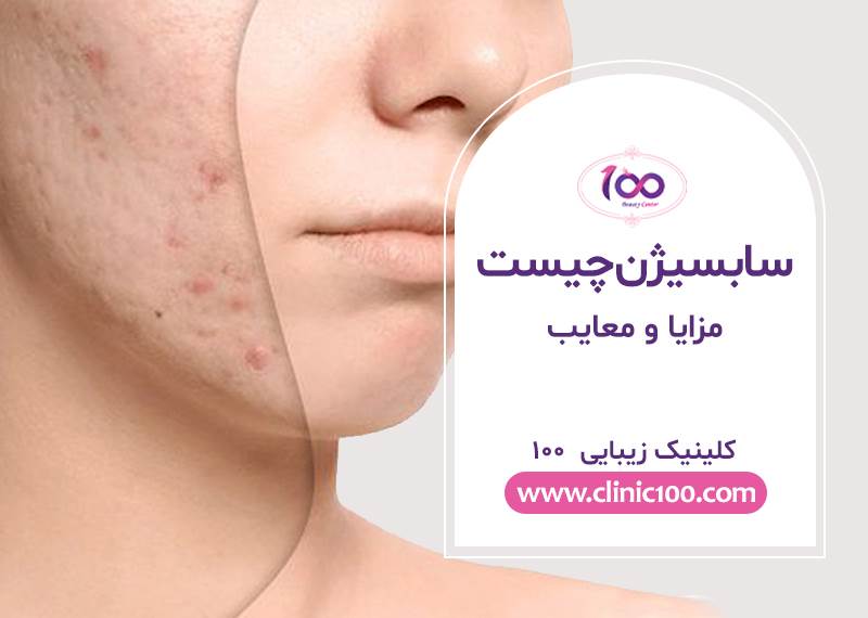 سابسیژن چیست-مزایا و معایب