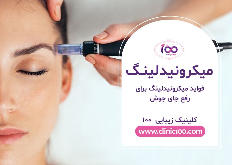 چگونه میکرونیدلینگ میتواند بهبودی در جای جوش ایجاد کند؟