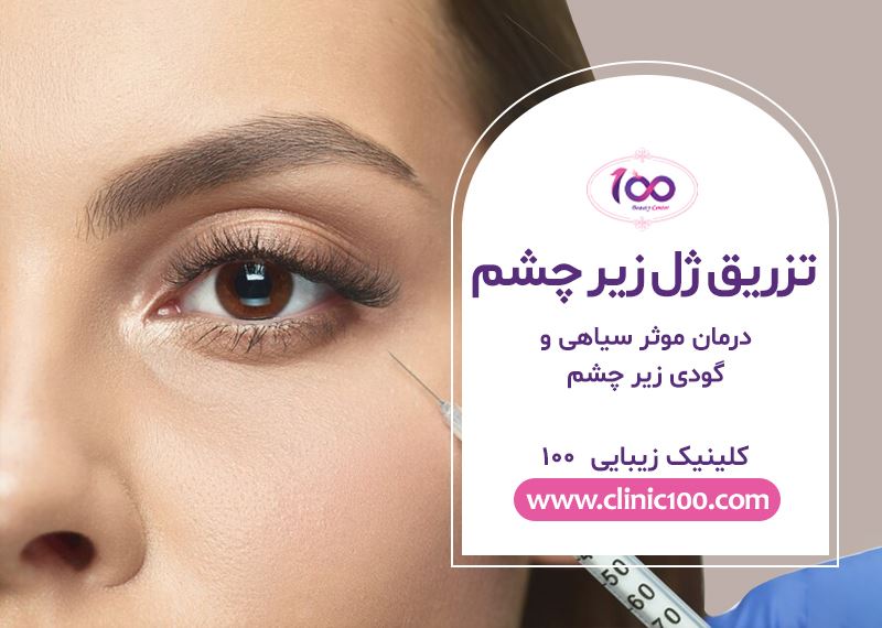 چگونه تزریق ژل به درمان سیاهی و گودی زیر چشم کمک میکند؟