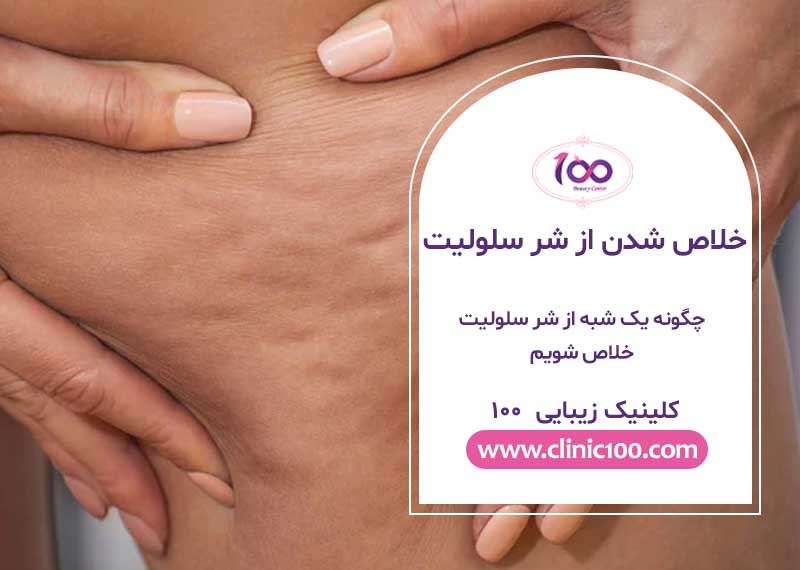 19 راه برای خلاص شدن از شر سلولیت یک شبه