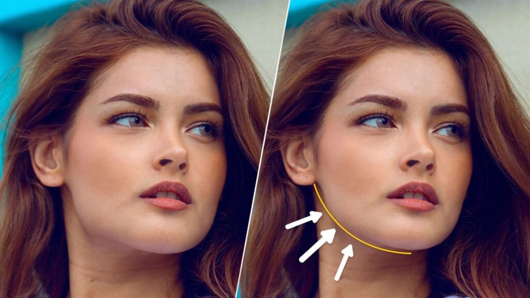 مقایسه بهترین روشهای غیر جراحی برای زاویهسازی صورت در کلینیک 100