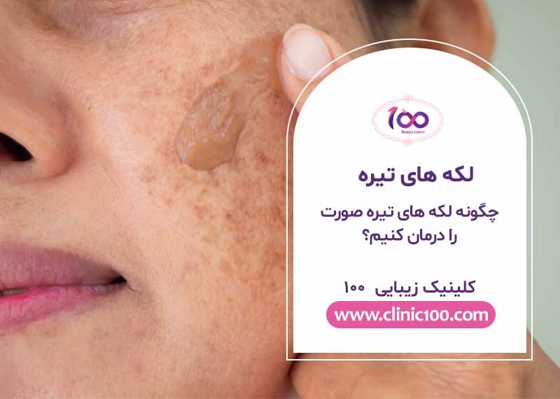 چگونه لکه های تیره صورت را درمان کنیم | درمان خانگی