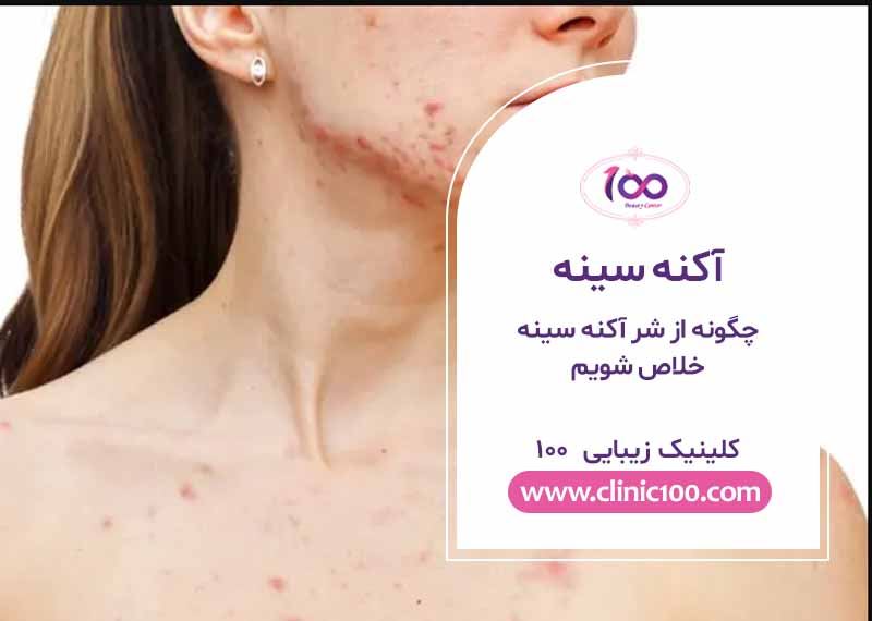چگونه از شر آکنه سینه خلاص شویم