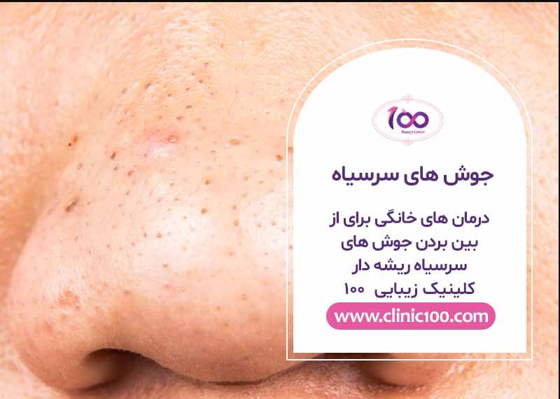 درمان های خانگی برای از بین بردن جوش های سرسیاه ریشه دار